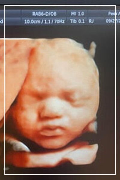 3D _ 4D _ 5D Ultrasound